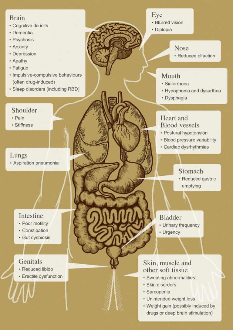 This picture illustrates potential non-motor features associated with Parkinson’s disease