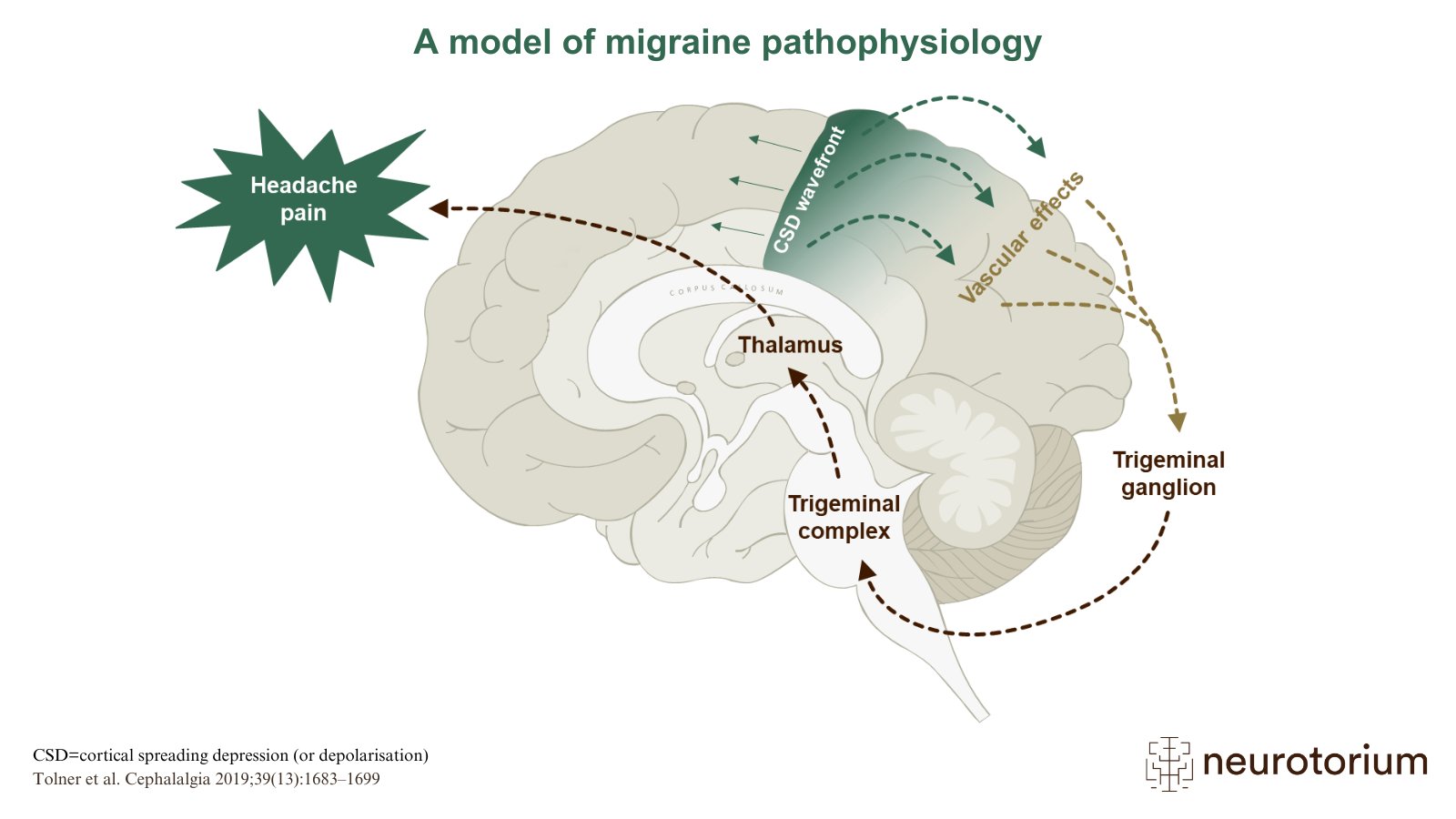 The image shows a schematic of how cortical spreading depression might interact with the trigeminovascular system in one proposed model of migraine pathology.