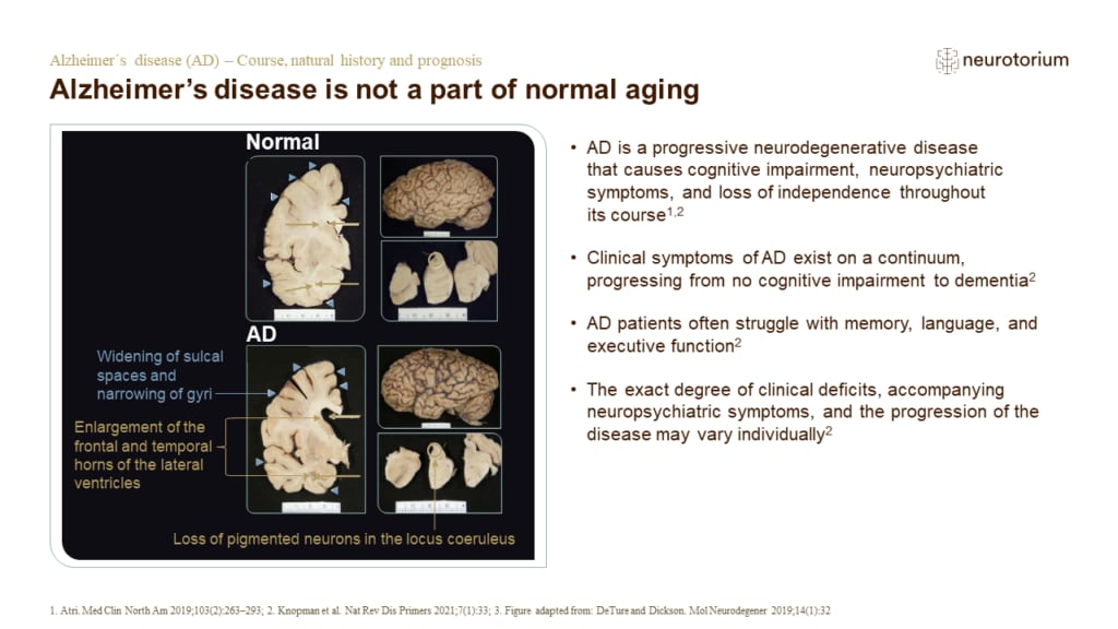 Alzheimer’s disease is not a part of normal aging