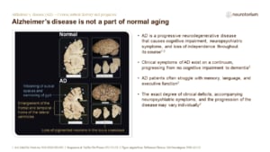 Alzheimer’s disease is not a part of normal aging
