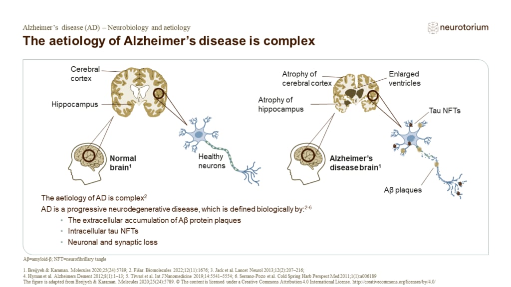 The aetiology of Alzheimer’s disease is complex
