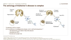 The aetiology of Alzheimer’s disease is complex