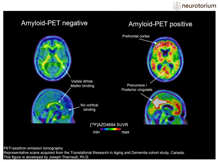 Examples of amyloid-negative (left) and amyloid-positive (right) positron emission tomography (PET) scans.
