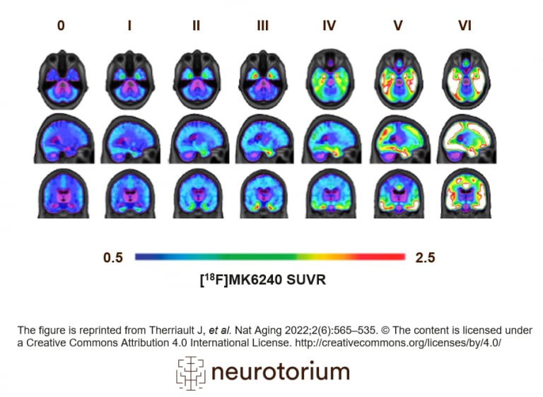 In vivo quantification of tau can be performed using tau-PET (PET: positron emission tomography). Tau-PET binds to insoluble neurofibrillary tangles, another core pathological feature of AD.