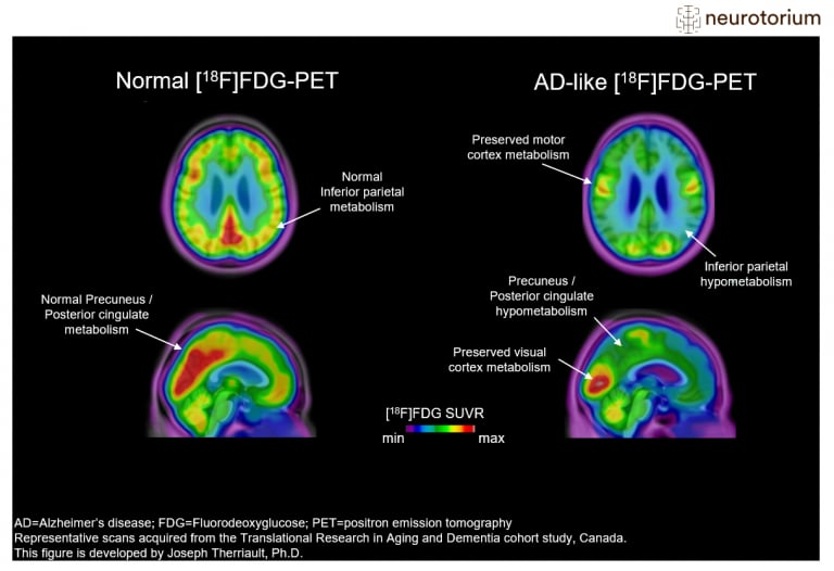 Representative images of Fluorodeoxyglucose PET ([18F]FDG-PET) images in a control subject (left) and a patient with advanced Alzheimer’s Disease (AD) (right).