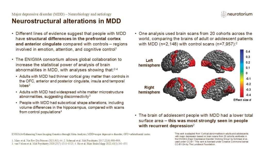 Neurostructural alterations in MDD