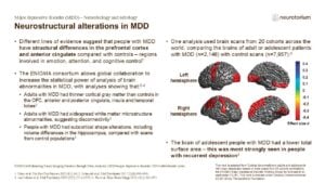 Neurostructural alterations in MDD
