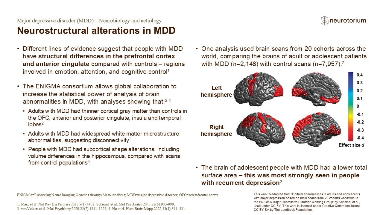 Neurostructural alterations in MDD