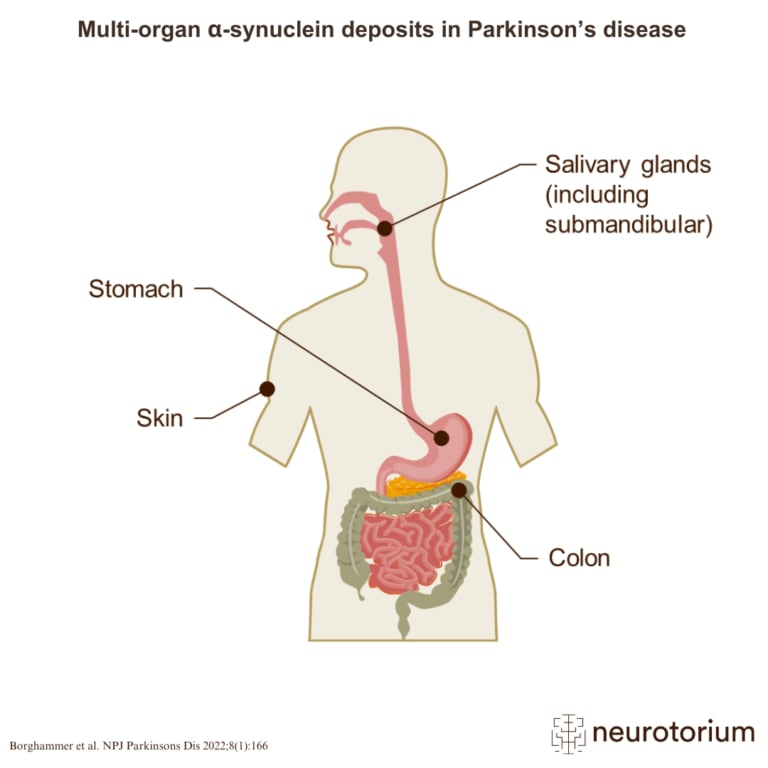 Illustration of α-synuclein protein deposits in multiple organs outside the brain in Parkinson’s disease, including the skin, stomach, colon, and salivary glands.