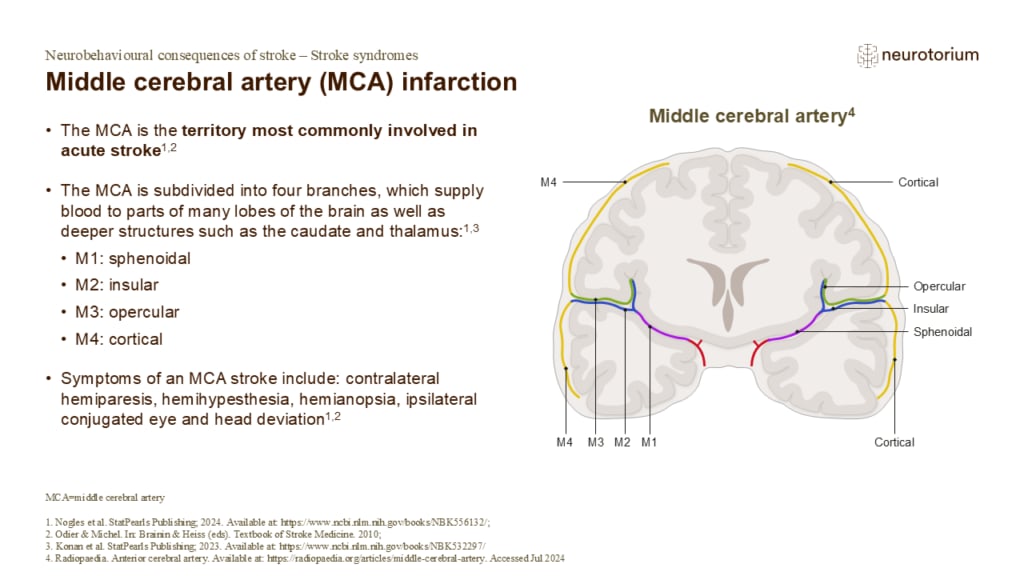 The Middle cerebral artery (MCA) infarction is the territory most commonly involved in acute stroke