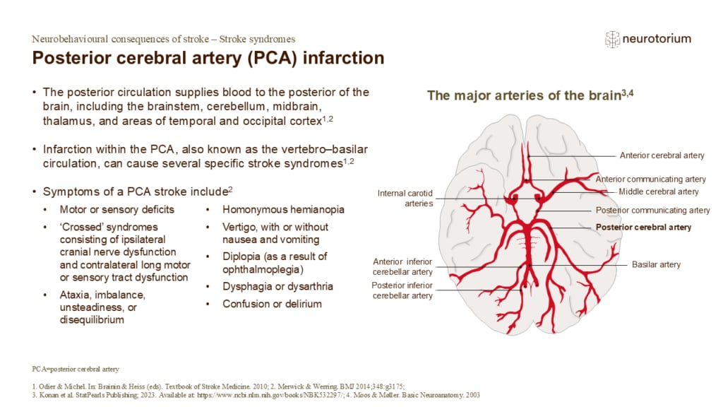 Posterior cerebral artery (PCA) infarction