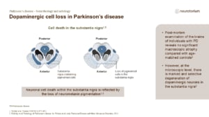 Dopaminergic cell loss in Parkinson’s disease