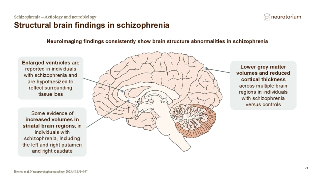 Slide showing structural brain findings in schizophrenia, highlighting enlarged ventricles, reduced grey matter volume and cortical thickness.