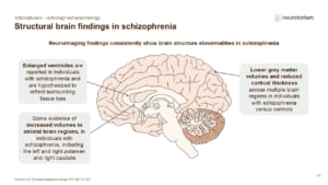 Slide showing structural brain findings in schizophrenia, highlighting enlarged ventricles, reduced grey matter volume and cortical thickness.