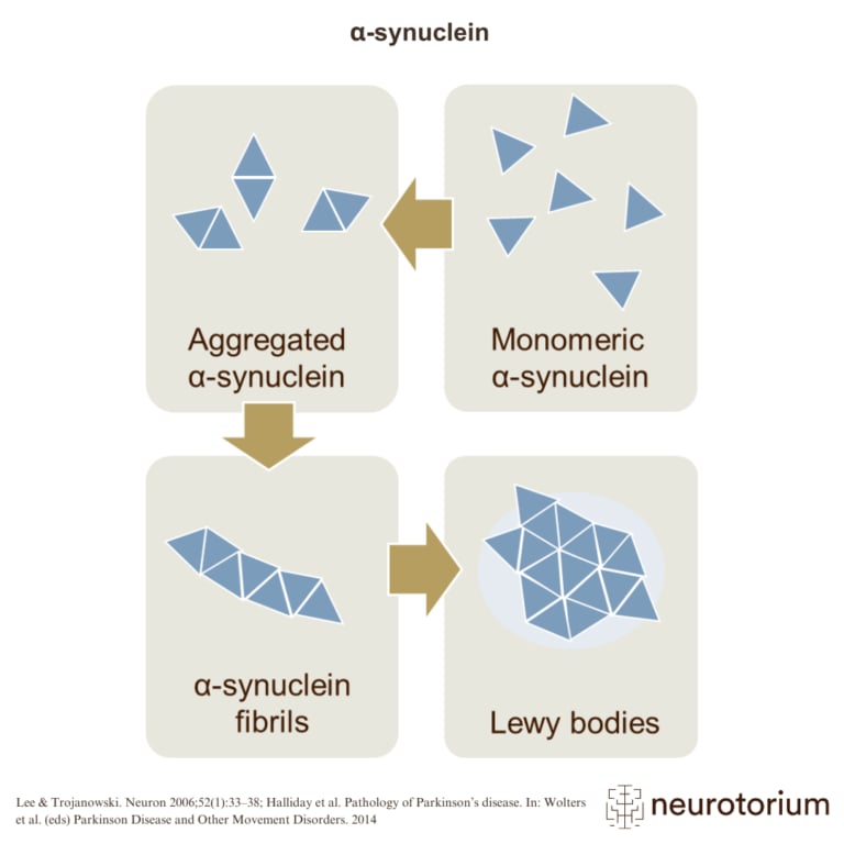 Diagram showing the progression of α-synuclein in Parkinson’s disease, from monomers to aggregates, fibrils, and finally Lewy bodies.