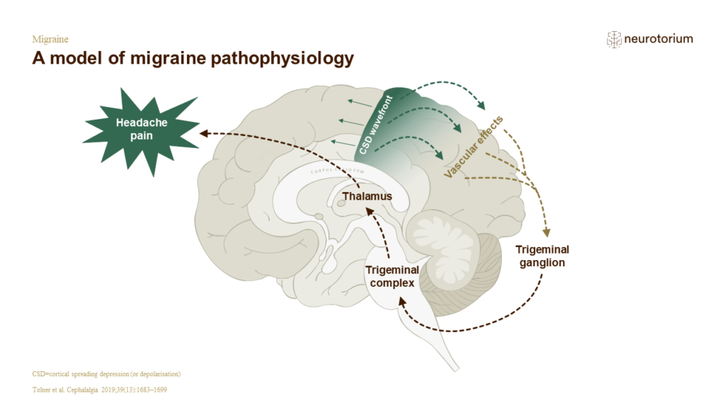 A model of migraine pathophysiology