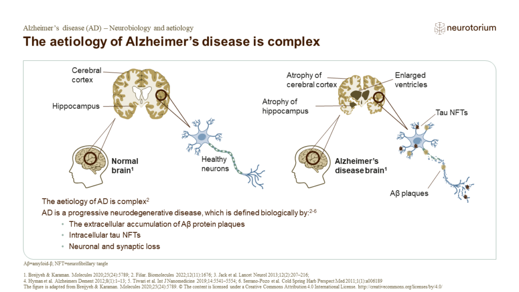 AD-Neurobiology & Aetiology slide14
