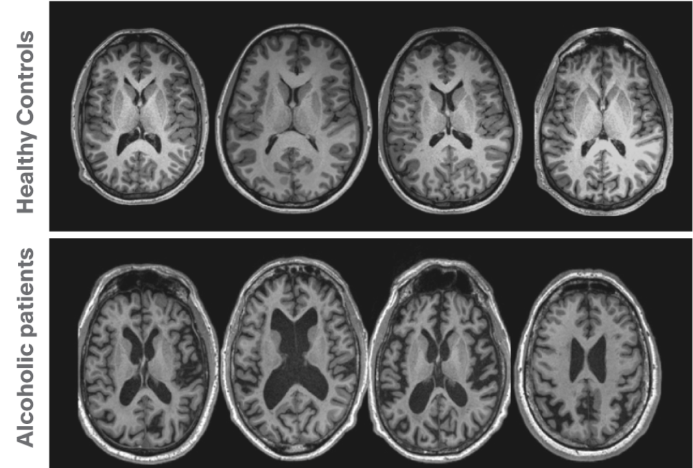 *add new title - MRI scans reveal brain damage from alcohol