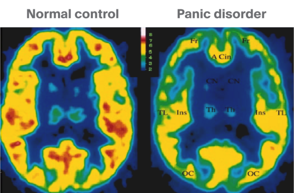 *add new tile - PET scan measuring GABA-A receptors in normal brain and in people with panic disorder