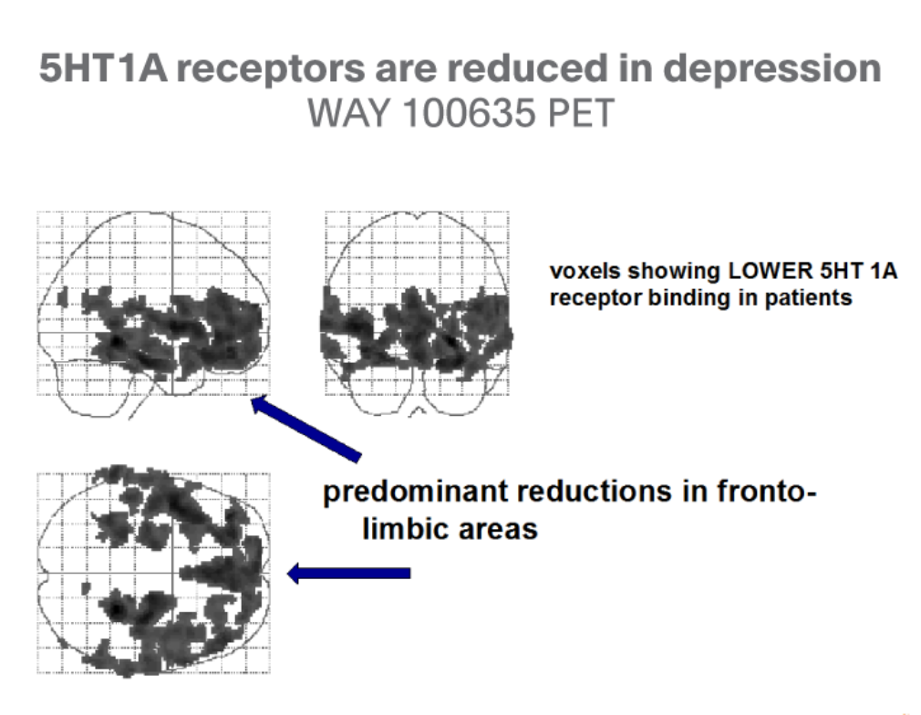 5-HT1A receptors are reduced in depression