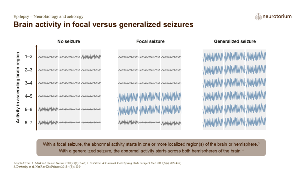 Brain activity in focal versus generalized seizures