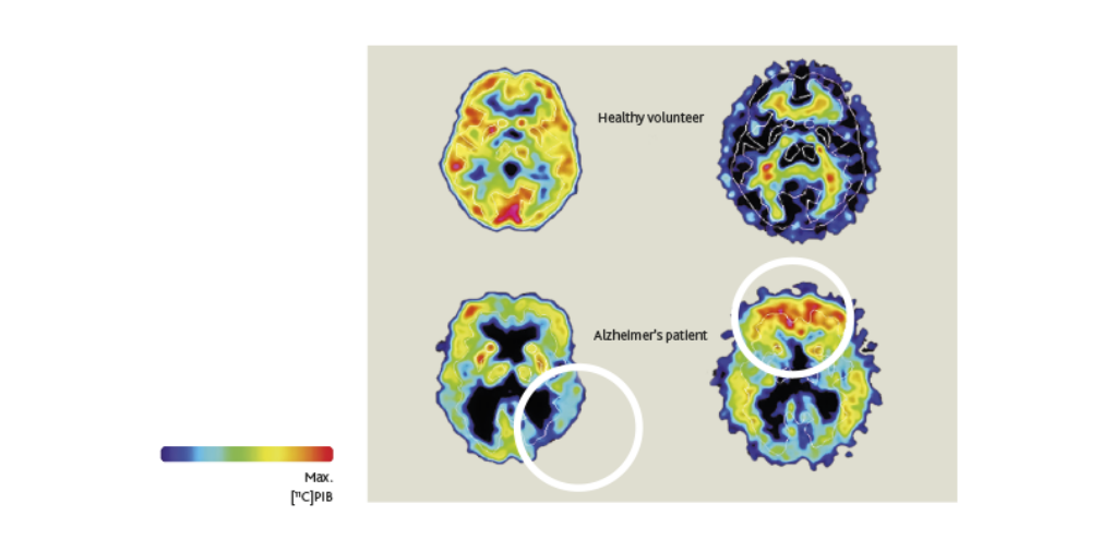 *add new title - Buildup of beta-amyloid proteins tracks the evolution of Alzheimer’s disease