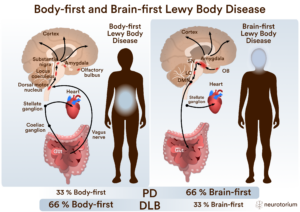 Characteristics of proposed body-first and brain-first subtypes of PD. Arrows indicate the direction of spread of α-synuclein pathology. In body-first Parkinson disease (left), the first α-synuclein aggregation occurs in the gut and propagates through the sympathetic nervous system to the sympathetic trunk and heart, and via the vagus nerve to the brainstem. Autonomic dysfunction and REM sleep behaviour disorder (RBD) are prodromal features. In brain-first PD (right), the initial α-synuclein pathology enters via the olfactory bulb (OB) and spreads to the amygdala and nigrostriatal dopamine system. The pathology then descends through the brainstem and RBD and dysautonomia generally develop after the onset of parkinsonism. During the later disease stages, nearly all patients have widespread pathology in these systems and their symptomatology therefore converges.