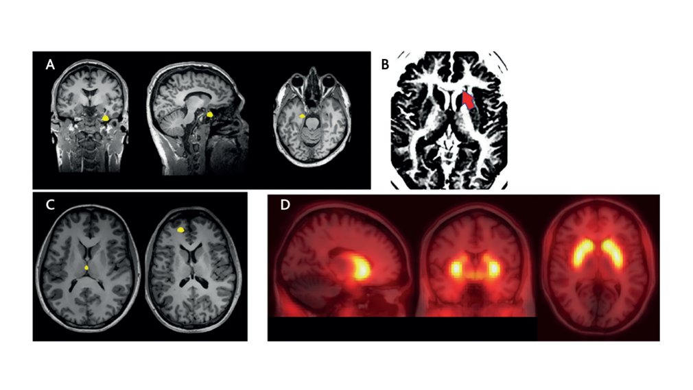 *add new title - Neuroimaging differences between patients with prodromal symptoms who do and do not later develop psychosis