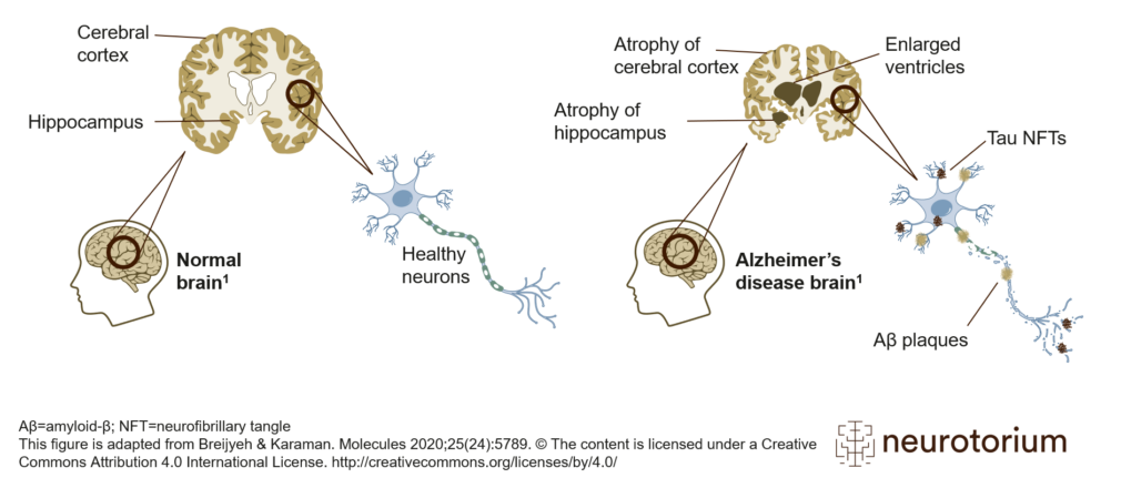 Alzheimer's disease brain with amyloid plaque and neurofibillary tangles