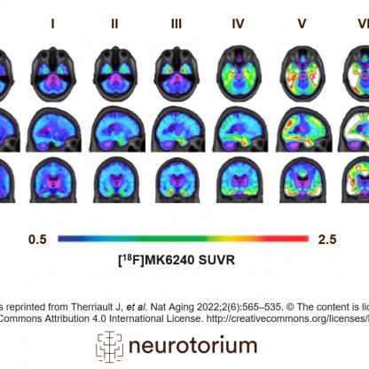 PET tau across stages of Alzheimer’s disease