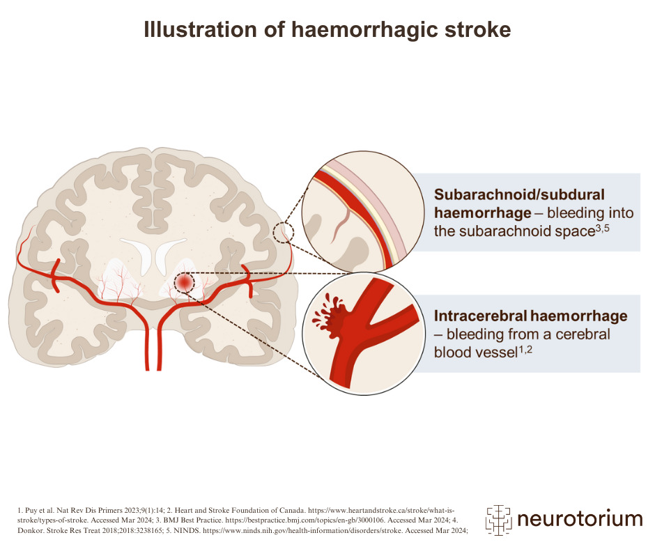 Roughly 1 to 2 in 5 cases of stroke are haemorrhagic. Haemorrhagic strokes are most commonly caused by an intracerebral haemorrhage.