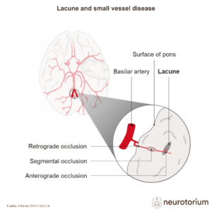 Lacunar infarctions are small subcortical infarcts,