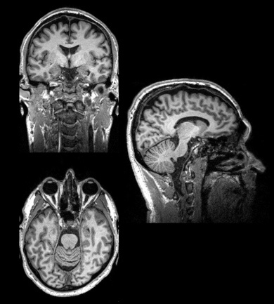 *add new title - The structure of a normal human brain revealed by MRI