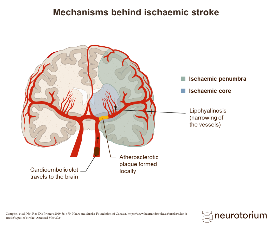 The pathology of stroke is complex, often involving many different interrelated arterial and cardiac conditions.