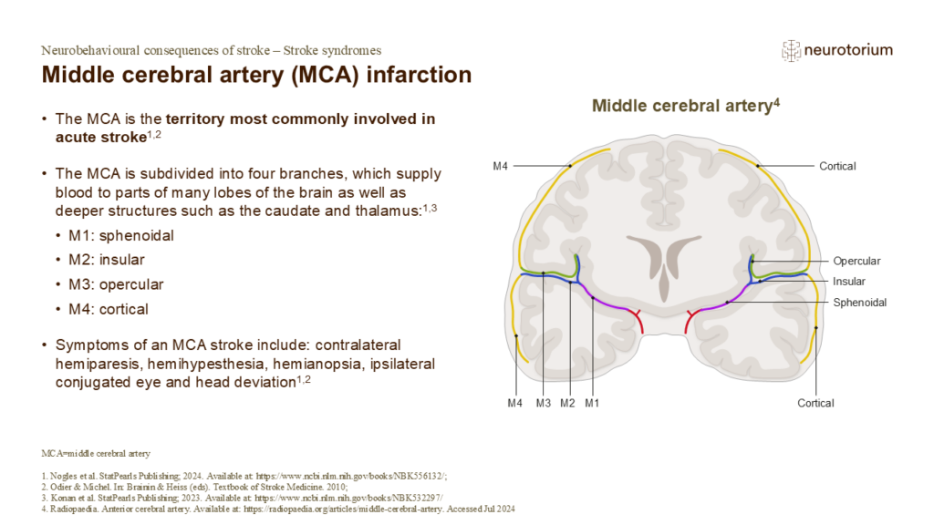 Middle cerebral artery (MCA) infarction