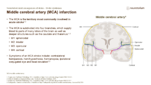 Middle cerebral artery (MCA) infarction