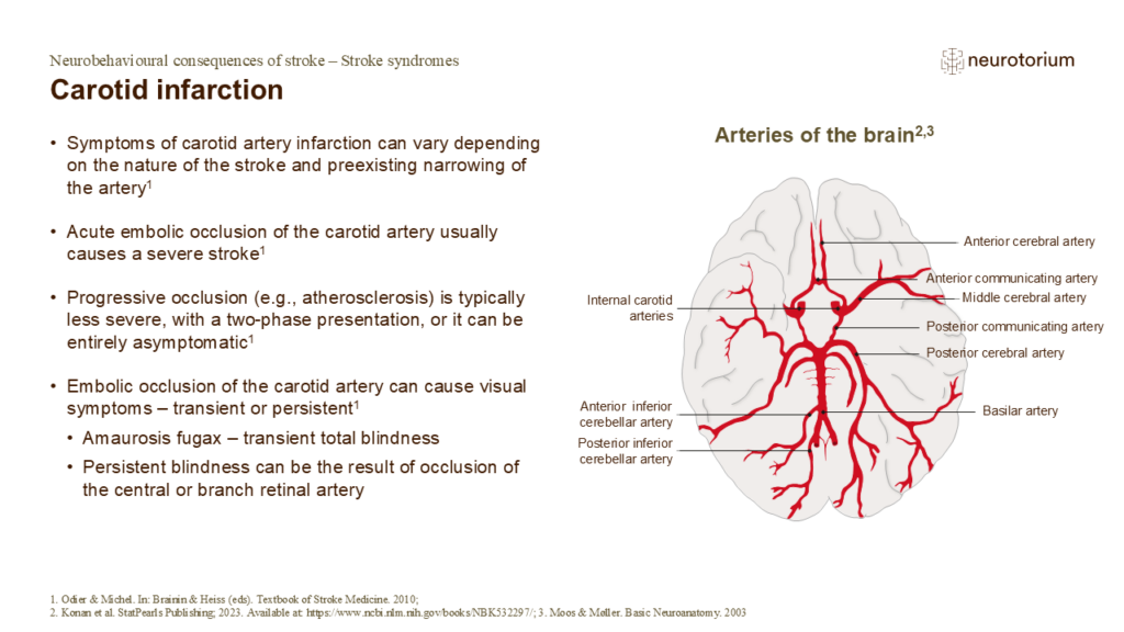 Carotid infarction