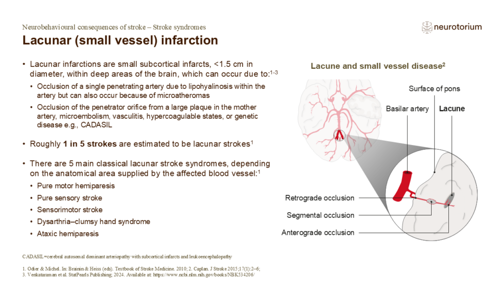 Lacunar (small vessel) infarction